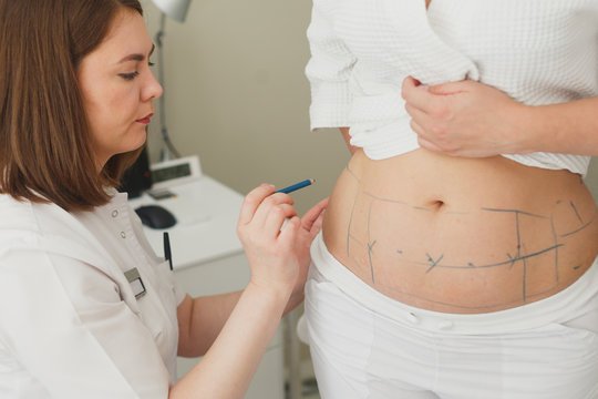 What Areas Can Be Treated With Liposuction?