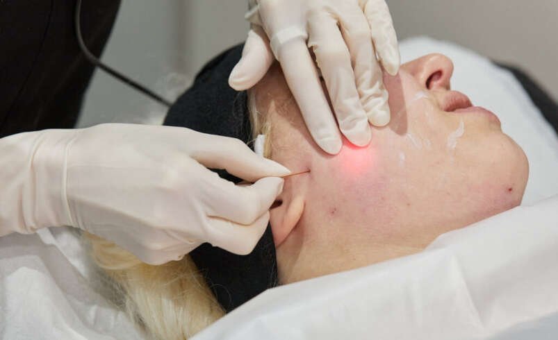 Endolift in London: How Is Facial Skin Structure Assessed During Consultation?