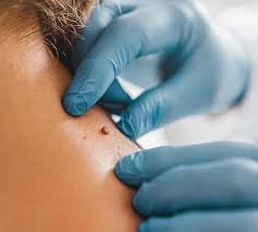 Moles Removal in Dubai: Achieve a More Even Skin Appearance
