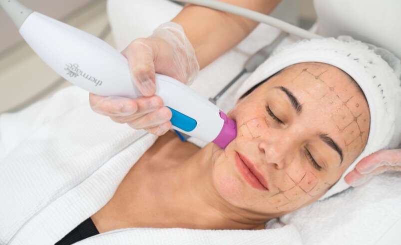 How Facial Contours Influence Thermage Skin Tightening in Dubai