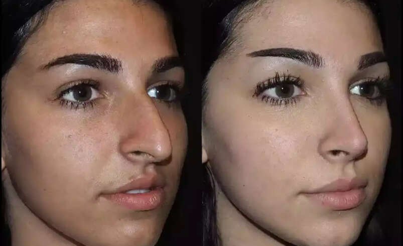 How Does Septoplasty in Dubai Help Restore Balanced Nasal Airflow?