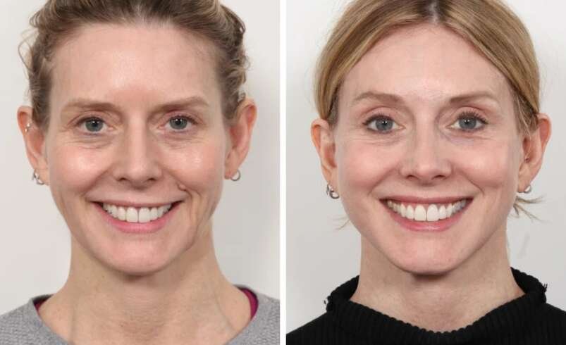 Best Plastic Surgeon in Dubai for Thread Lift Jawline Definition