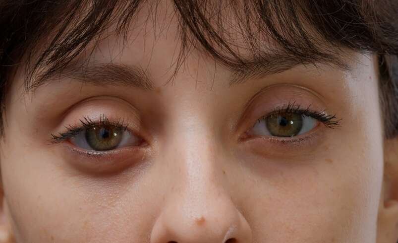 Eyelid Bag Surgery Dubai: How Does Lower Eyelid Skin Laxity Influence Surgical Planning?